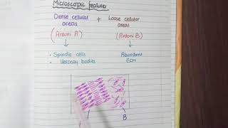 Schwannoma Pathology [upl. by Tirreg]