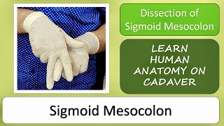 Dissection of sigmoid mesocolon [upl. by Valdemar]