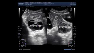 Ultrasound Video showing Two types of Ovarian Cysts and an Ovarian Mass [upl. by Tiebout]