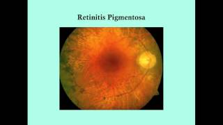 Retinitis Pigmentosa  CRASH Medical Review Series [upl. by Liliane]