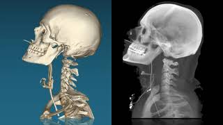 cervical spine trauma [upl. by Wolcott592]