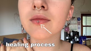 lip piercing healing process days 17 [upl. by Salvidor]