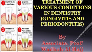 11Treatment of various conditions in dentistry gingivitis and periodontitis – Wadhah lecturesوضاح [upl. by Stanfill]