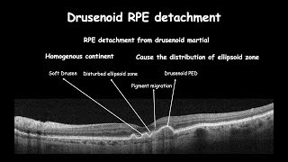 Clinical changes in RPE course  Drusen [upl. by Cedric979]