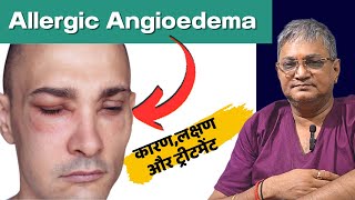 Allergic Angioedema  angioedema treatment  angioedema lips in hindi  angioedema and urticaria [upl. by Enilorak144]