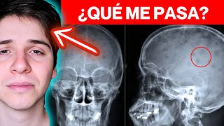 MIELOMA MÚLTIPLE ► FISIOPATOLOGÍA y SÍNTOMAS  EXPLICACIÓN MAESTRA en 8 MINUTOS MÍRALO 😲😲😲😲😲😲😲 [upl. by Elissa]