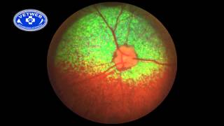 SARDS Sudden Acquired Retinal Degeneration Syndrome [upl. by Lewak]