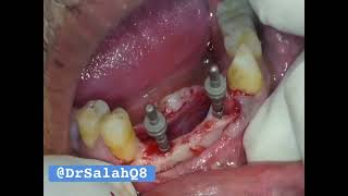 Immediate implant  surgical delayed implant  Flapless implant placement all at the same time [upl. by Meir]