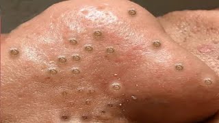 Big Cystic Acne Blackheads Extraction Blackheads amp Milia Whiteheads Removal Pimple Popping  2509 [upl. by Linette]