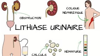 LITHIASE URINAIRE Signes et Symptômes diagnostic traitement  Complications [upl. by Swords373]