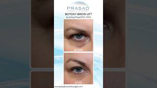 How the Botox Brow Lift Works botox [upl. by Etteraj]