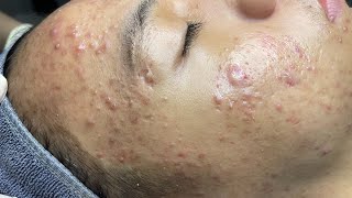 ACNE TREATMENT VU QUYNH MI  Perennial Blackheads On Boy Face 2024FULL [upl. by Ennail525]