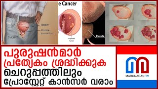 പുരുഷന്‍മാരുടെ ശ്രദ്ധക്ക് പ്രോസ്റ്റേറ്റ് കാന്‍സര്‍ ചെറുപ്പക്കാരിലും പിടിമുറുക്കുന്നു [upl. by Yodlem80]