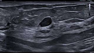 12 Breast Papillary Tumor 18L7  Ultrasound Aplio aseries  Canon Medical Systems [upl. by Four]