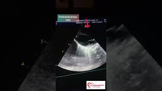 Perimembranous VSD  VSD  congenital heart anomalies  VSD Echo [upl. by Frere]