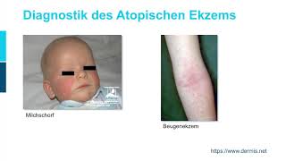 Dermatologie ─ Atopische Dermatitis Teil 12 [upl. by Enyrehtac]