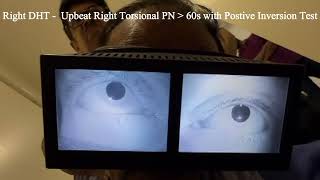 Right Posterior Semicircular Cupulolithiasis with Positive Inversion Test [upl. by Pickens]