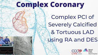 Watch Live Complex PCI of Severely Calcified amp Tortuous LAD using RA and DES [upl. by Bridget]