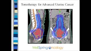 Radiation and Endometrial Cancer [upl. by Addam]