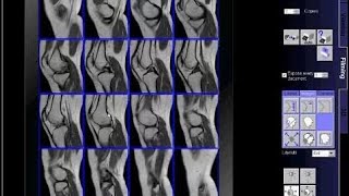 How to do MRI KNEE FILMING MRI KNEE [upl. by Ivz]