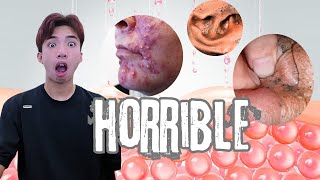 The Scariest Pimple Popping Videos Youve Ever Seen 3 [upl. by Releyks]