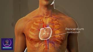 Cardiac Tamponade Treatment  Cardiac Surgery Procedure 3D Animation [upl. by Ocirred742]