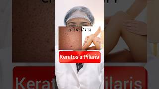 Keratosis Pilaris🦵क्या आपको भी है🤔 skin glow trending [upl. by Yenruoc]