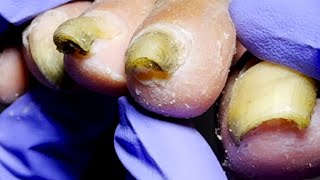 Contagious Onychomycosis Trim It Clean【Dr Lius Pedicur Branches】 [upl. by Tandy]