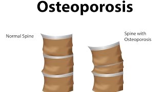 What is Osteoporosis [upl. by Nangem]