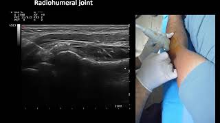 Ultrasound guided elbow radiohumeral joint injection by Prof Murat Karkucak MD [upl. by Blood]