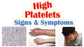 High Platelets Thrombocytosis Signs amp Symptoms  Rapid Review [upl. by Asirahc]