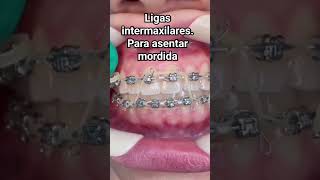 ligas intermaxilares para asentar la la mordida brackets dentistas ortodoncia [upl. by Ycart]