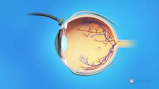 Vitrectomy Surgery for Macular Holes [upl. by Bernardina]