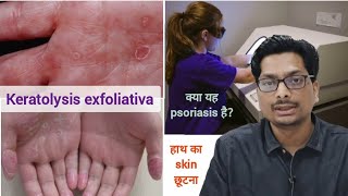 हाथ का skin छूटना  क्या यह psoriasis है Keratolysis exfoliativa  Peeling of hand skin psoriasis [upl. by Feltie]