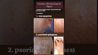 Dermatological signs papules acne acnetreatment psoriasis plaques [upl. by Nnairrek]