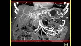 Abdomen Pancreas Pancreatic cancer  3D mapping using volume rendering and MIP2 of 2 [upl. by Sivet]