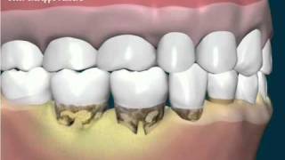 Tartaro e formazione di tasca subgengivalewmv [upl. by Ardnola]