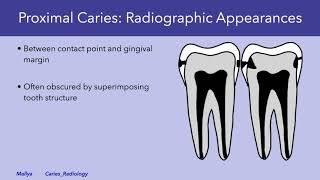 Radiologic Detection and Evaluation of Caries [upl. by Jonette]