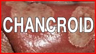 What is Chancroid Or Soft Chancre Early signs Symptoms and Causes of Soft Chancre [upl. by Alex]