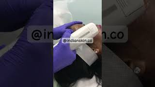 Fox eye lift  non surgical facelift  Hifu treatment in Nagpur nagpurskinclinic hifu foxeyes [upl. by Collin840]