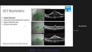 OCT Biomarkers and Anti VEGF Therapy for Diabetic Macular Edema Dr Muna Bhende [upl. by Neiviv547]