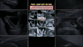 👶🏻Find Baby Boy OR Girl🤔 medicalimaging ultrasound baby youtubeshorts pregnancy gender 100k [upl. by Lletnwahs687]