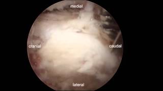 Endoscopic decompression for lumbar stenosis by UBE [upl. by Ellehsar]