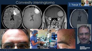 Keyhole Meningioma Removal with Dr Daniel Kelly [upl. by Pattin]