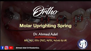 Molar upright spring Wire Bending  Orthodontics [upl. by Lindgren]