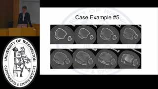 Posterior Malleolus Fractures Why We Should Care [upl. by Ahsemat]