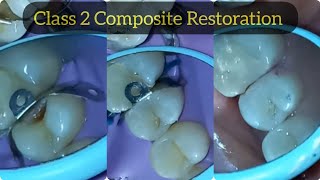 Composite Restoration of Class 2 Cavity in Upper Premolar  Posterior Composite Filling [upl. by Hsemin840]