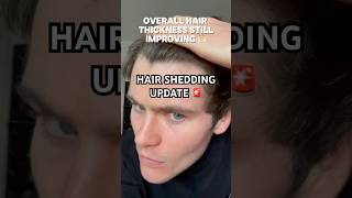 HAIR SHEDDING UPDATE 🚨 hairloss hairline [upl. by Nhguavad700]