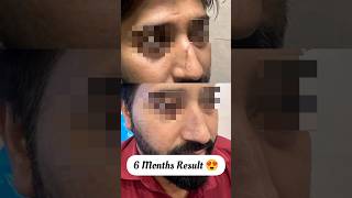 6 Months Nose Scar Revision  Before amp After Results  Dr Pankaj Mehta [upl. by Deenya]