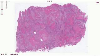 Histopathology  Squamous Cell Carcinoma of the Lung [upl. by Monroe]